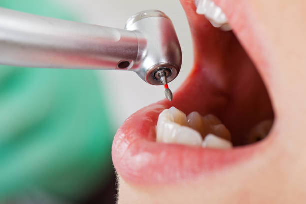 Best Emergency Dental Extractions in Camp Point, IL